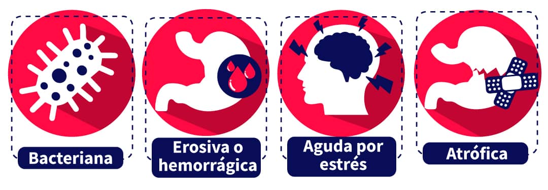 esquema informativo de los tipos de gastritis