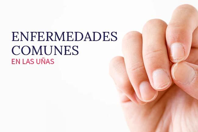 enfermedades-comunes-en-las-unas