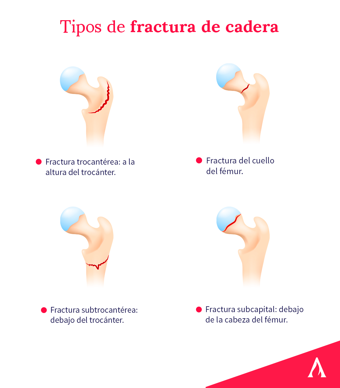 tipos-de-fractura-de-cadera