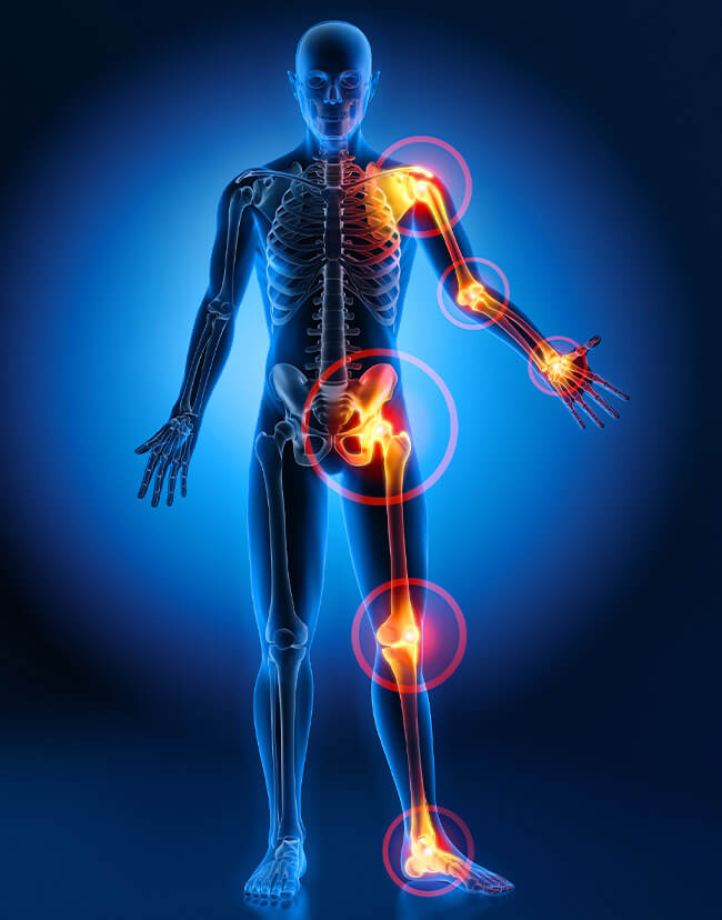 fibromialgia-puntos-de-dolor