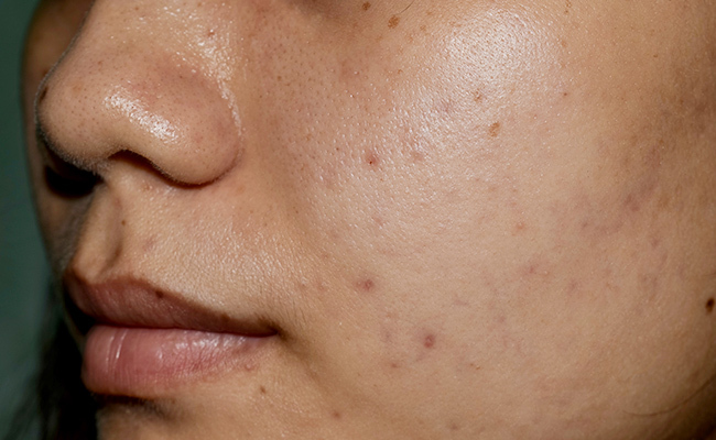 marcas-de-acne-en-la-piel
