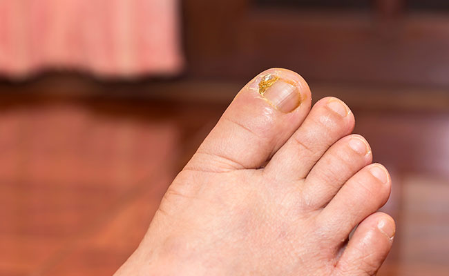 pie con una infección en una uña
